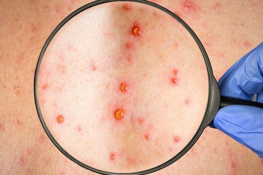 Đậu mùa khỉ lây truyền từ người sang người