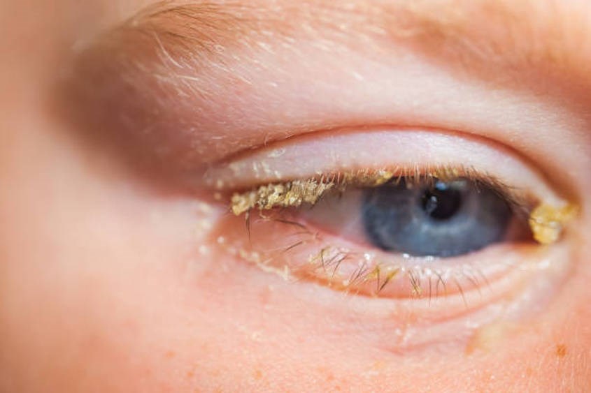 Chảy chất nhầy nơi khoé mắt - Nguồn: istockphoto