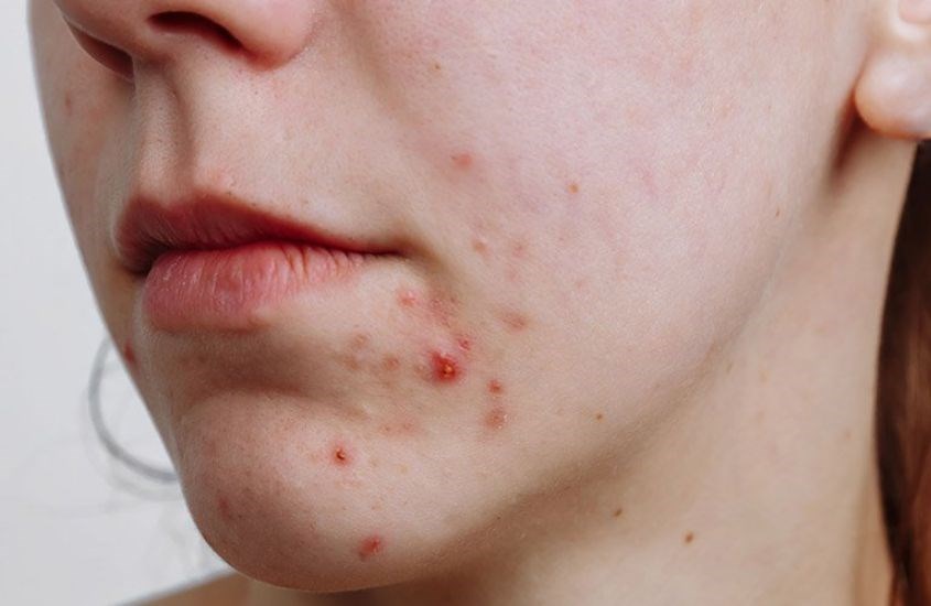 Lactoferrin còn cải thiện các bệnh ngoài da