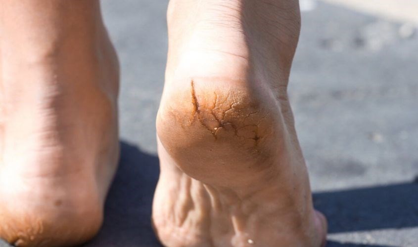 Tinh bột nghệ có khả năng chữa lành vết thương ở gót chân nhanh chóng