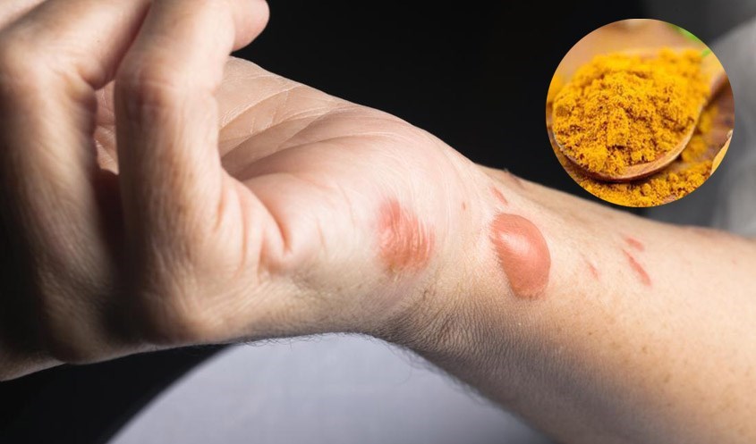 Tinh bột nghệ giúp điều trị bỏng rát