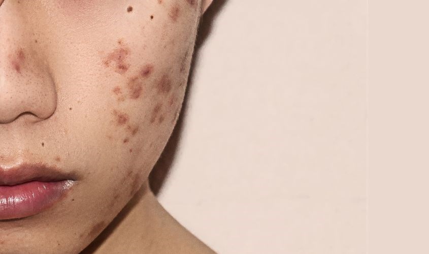 Mỹ phẩm hết hạn chứa vi khuẩn làm tổn thương da