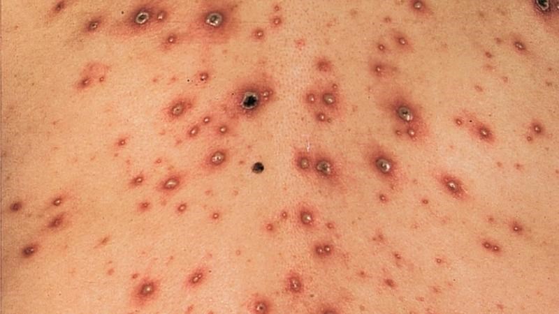 Các mụn mủ se lại thành nốt đen là một trong những dấu hiệu lui bệnh
