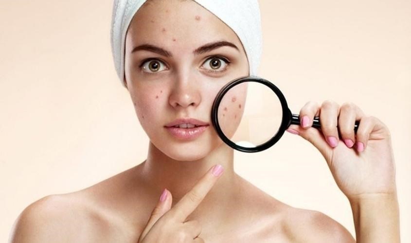 Dị ứng sữa rửa mặt khiến da nổi mẩn đỏ, nổi mụn