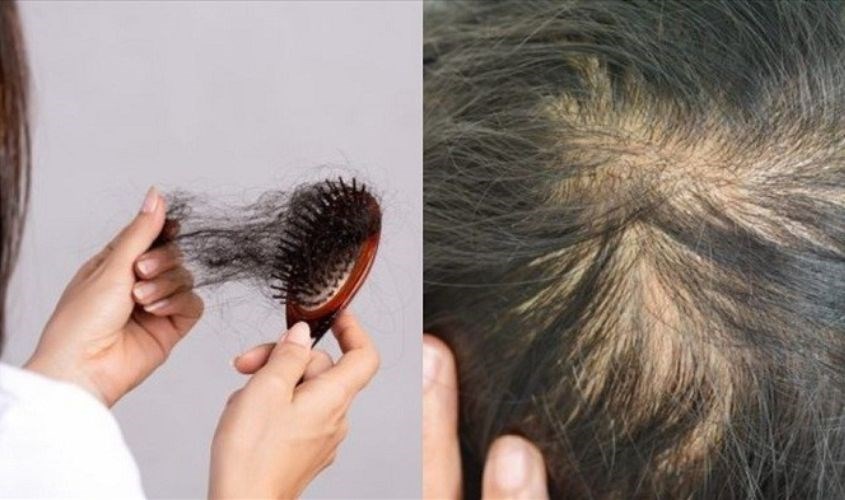 Nguyên nhân rụng tóc chủ yếu là do chu kỳ và tuổi trọ của tóc