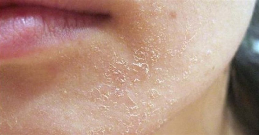 Dấu hiệu nhận biết da khô