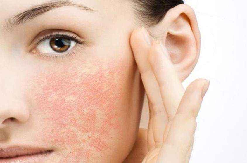 Dấu hiệu nhận biết da nhạy cảm