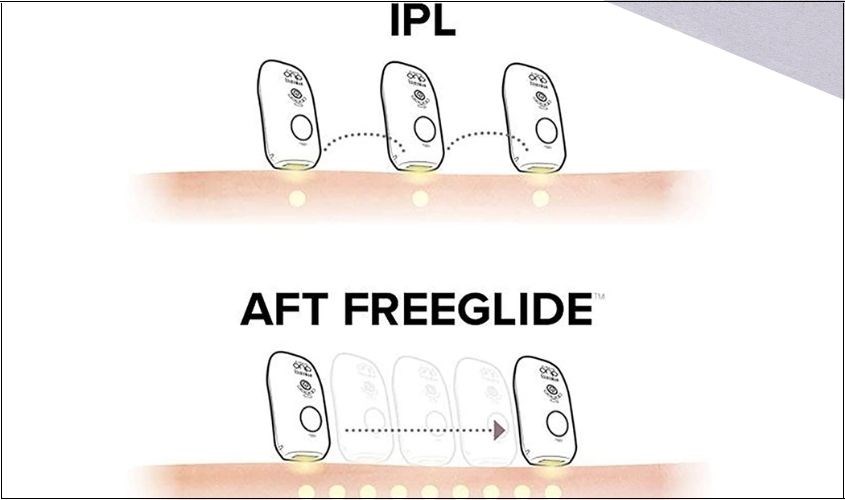 Công nghệ máy triệt lông Homedics