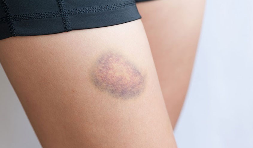 Thiếu vitamin K khiến cơ thể thường xuyên xuất hiện các vết bầm tím không rõ nguyên nhân