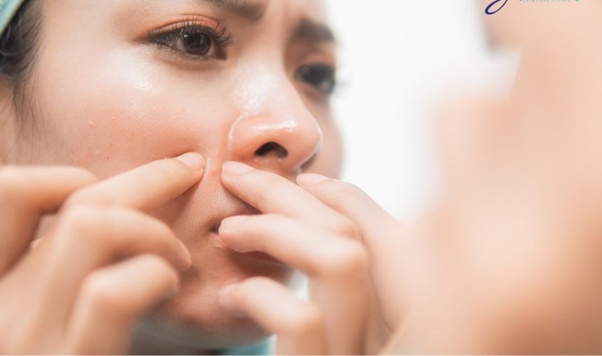 Đẩy mụn là hiện tượng nhân mụn bị trồi lên trên bề mặt da