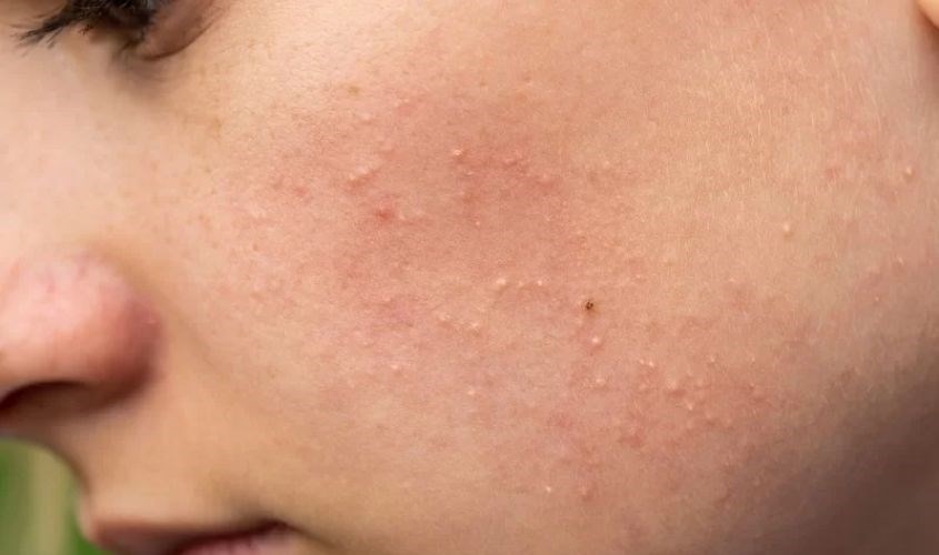 Làn da đang trong quá trình đẩy mụn