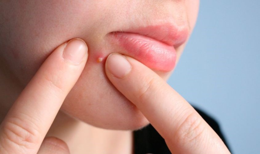 Chỉ nên nặn mụn ẩn khi phần nhân đã khô cứng và gom cồi lại