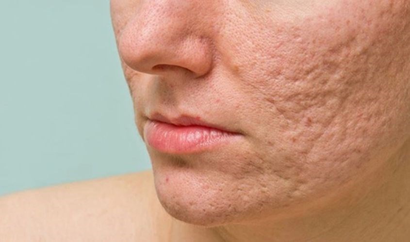Nặn mụn sai cách sẽ hình thành nên sẹo rỗ gây mất thẩm mỹ