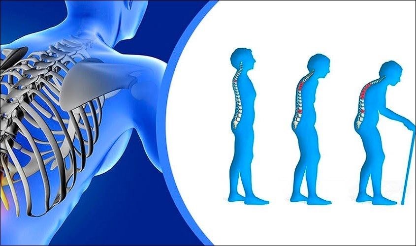 Fluor có vai trò quan trọng giúp hình thành xương và khôi phục vị trí gãy xương