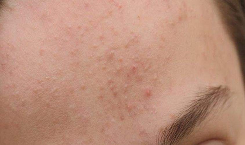 Mụn ẩn sờ vào sần sùi và không có dấu hiệu sưng tấy