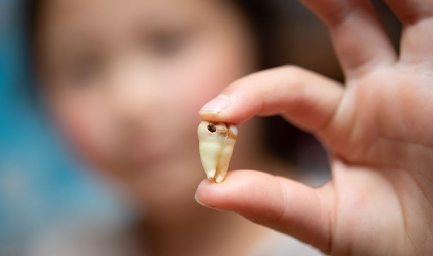 Đánh răng quá thường xuyên có thể gây nên tác dụng phụ dẫn đến sâu răng