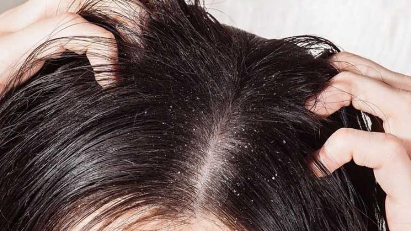 Dầu gội Head and Shoulder có khả năng trị nấm da đầu từ nhẹ đến nặng