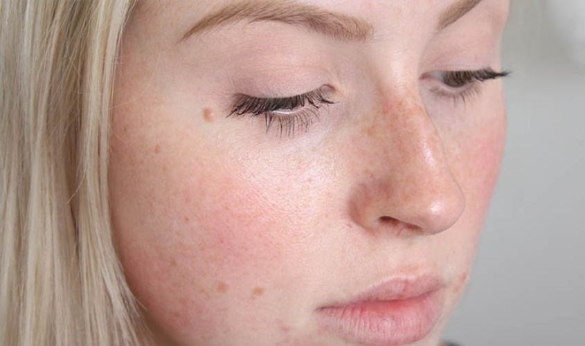 Dừng lại ngay nếu cảm thấy ngứa ngáy, mẩn đỏ