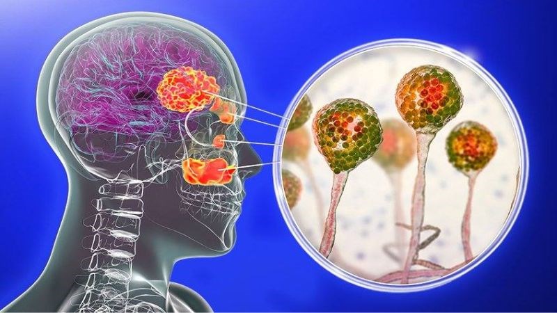 Viêm xoang do nấm không lây từ người này sang người khác 