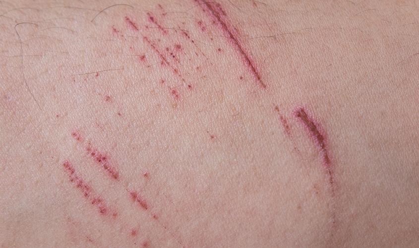 Không sử dụng máy triệt lông IPL cho vùng da bị trầy xước