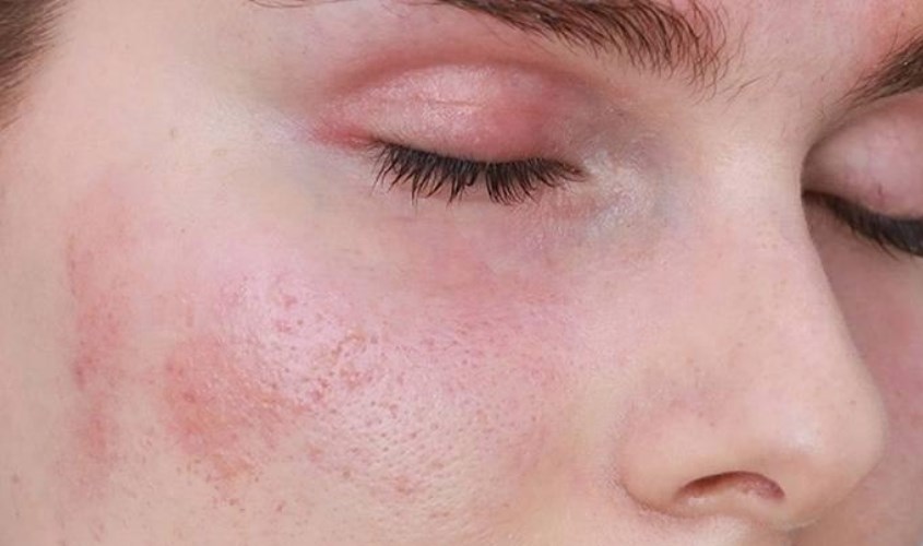 Azelaic acid không thể sử dụng cho mọi loại da, cần tham khảo ý kiến bác sĩ trước khi dùng