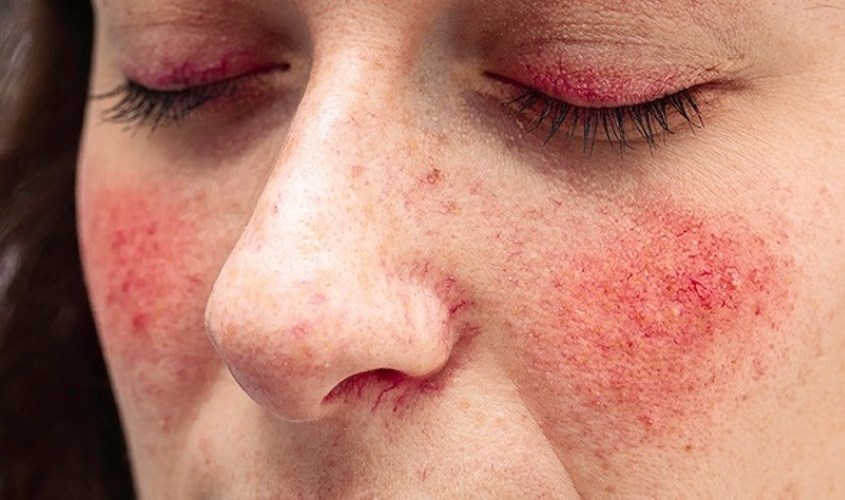 Giảm tăng sắc tố da