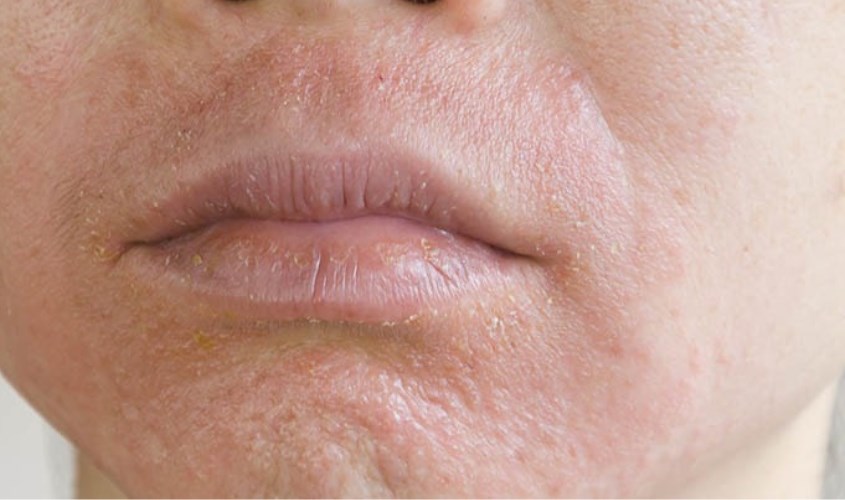 Nên thăm khám bác sĩ khi da tấy đỏ, bong tróc, châm chích,... sau khi sử dụng hoạt chất