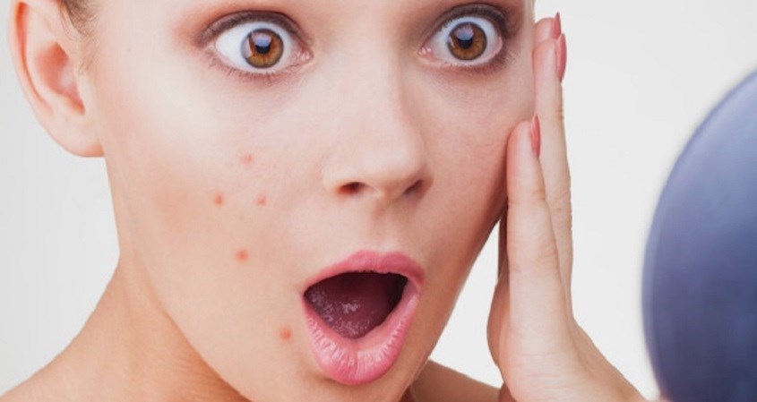 Ăn nhiều đậu phộng sẽ gây nóng trong người, dễ bị nổi mụn