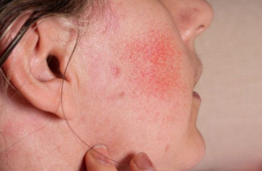 Có cơ địa dị ứng thì không nên ăn đậu phộng