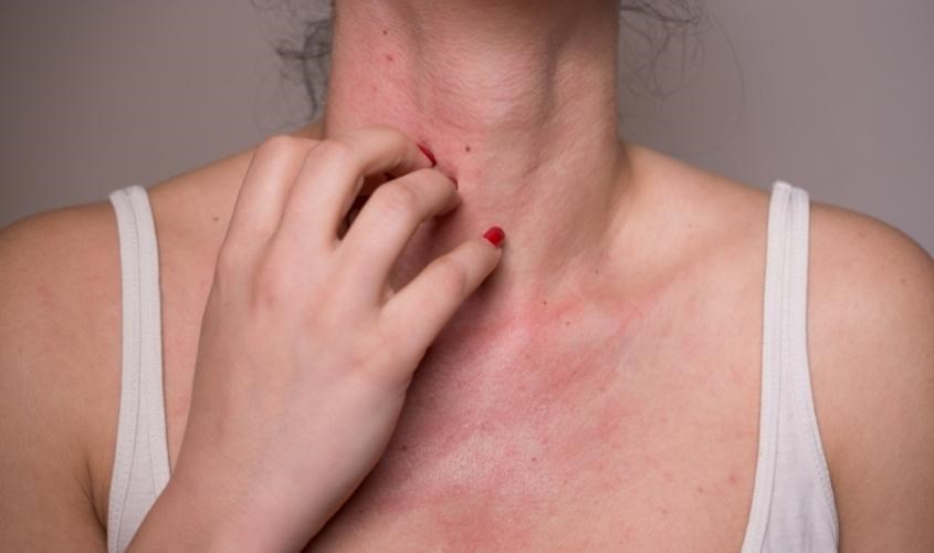 Ngưng sử dụng mật ong chúa ngay khi bị dị ứng