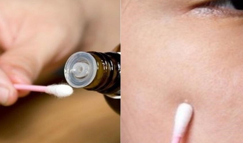 Thoa trực tiếp dầu mù u giúp vết sẹo mờ đi nhanh chóng