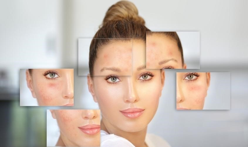 Lưu ý khi dùng dầu mù u trị sẹo để đạt hiệu quả cao