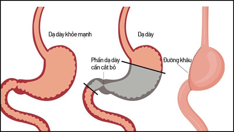 Phẫu thuật cắt bỏ một phần dạ dày khi khối u ở phần thấp dạ dày gần ruột non