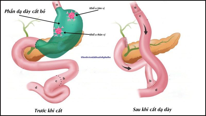 Phẫu thuật cắt bỏ toàn bộ dạ dày