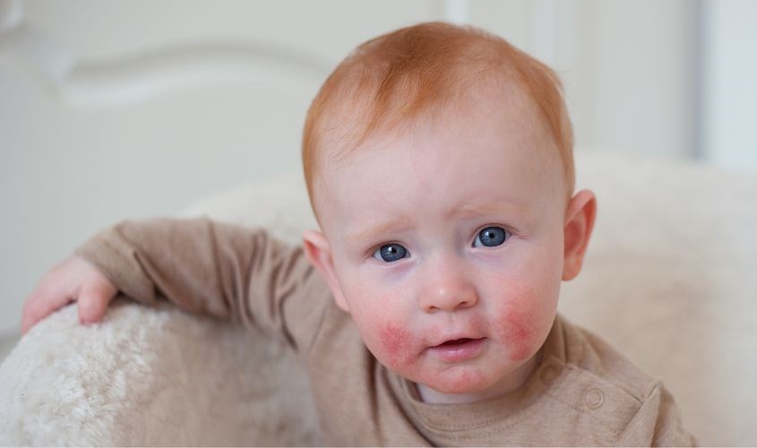 Ngăn ngừa và hỗ trợ làm giảm viêm nhiễm da