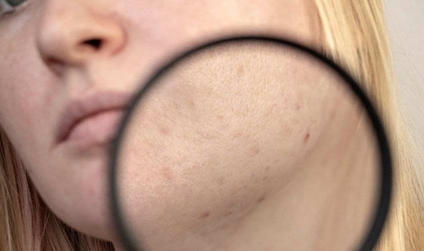 Sử dụng nước máy không được xử lý tốt lâu ngày gây bít tắc lỗ chân lông