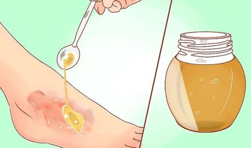 Mật ong có thể giúp chúng ta trị bỏng nhanh chóng Mật ong có thể giúp chúng ta trị bỏng nhanh chóng