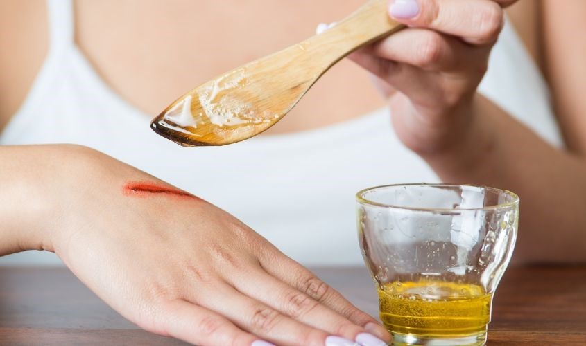 Chữa lành vết thương nhanh chóng với mật ong Chữa lành vết thương nhanh chóng với mật ong