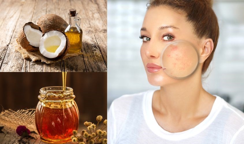9 lợi ích làm đẹp tuyệt vời từ dầu dừa mật ong