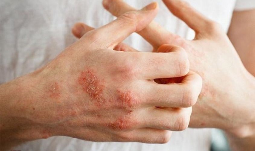 Hỗn hợp dầu dừa cùng mật ong hỗ trợ điều trị vết chàm