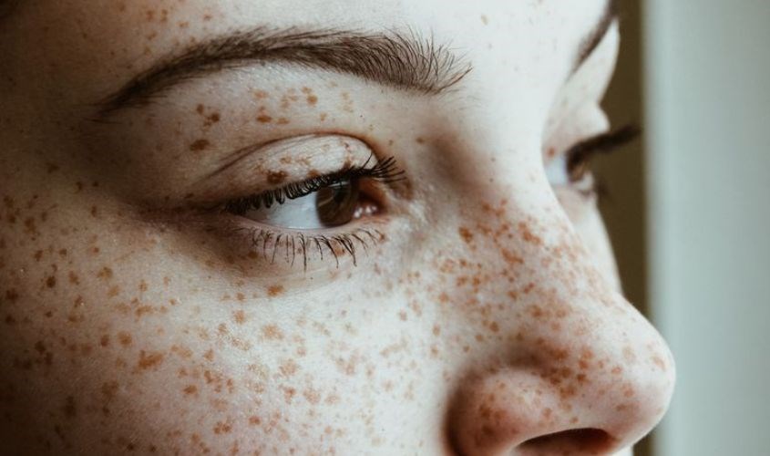 Thoa đều hỗn hợp dầu dừa và mật ong sẽ giúp bạn trị nám, tàn nhang