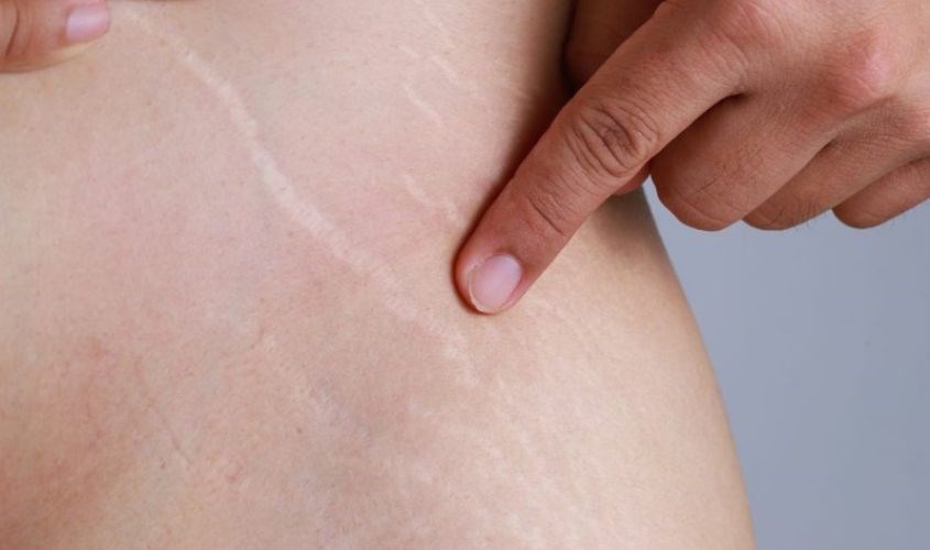 Chất chống oxy hóa mạnh mẽ trong dầu dừa và mật ong giúp làm mờ vết rạn da