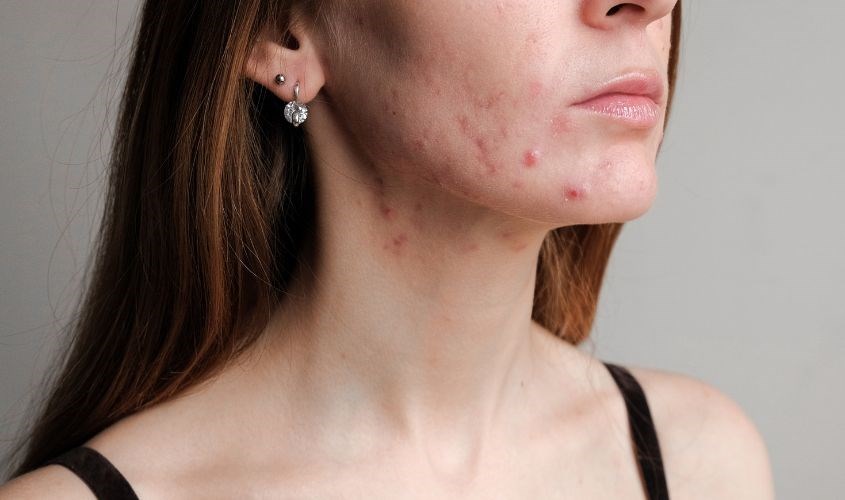 Đeo khẩu trang bị nổi mụn là do tắc nghẽn lỗ chân lông, khiến da trở nên bí bách và gây mụn Đeo khẩu trang bị nổi mụn là do tắc nghẽn lỗ chân lông, khiến da trở nên bí bách và gây mụn
