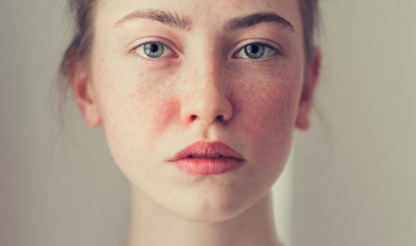 Khi sử dụng dầu mù u trị mụn cần theo dõi thường xuyên để phát hiện kích ứng nếu có