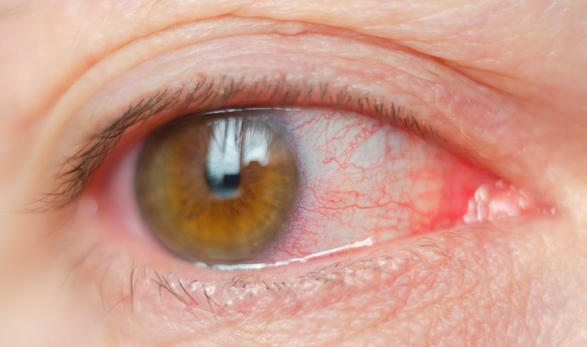 Khi tiếp xúc trực tiếp với mắt, dầu mù u sẽ gây ra một số kích ứng như chảy nước mắt, đau xót