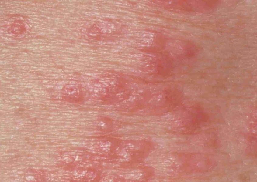 Nếu da trẻ bị phồng rộp, cần đưa ngay trẻ tới gặp bác sĩ. Nguồn từ Verywell Health