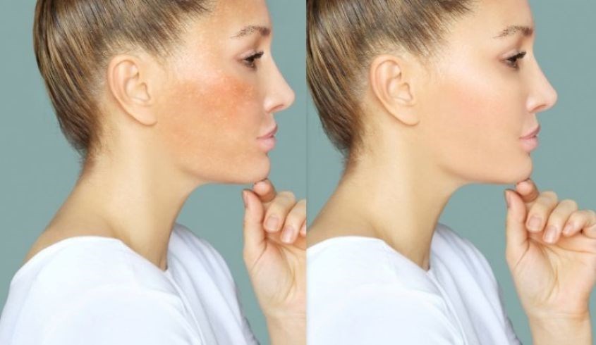 Tranexamic Acid có tác dụng làm mờ đi các vết đổi màu do tiếp xúc tia UV