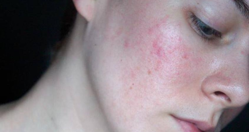 Không dùng nhiều Acid cùng lúc tránh làm da kích ứng