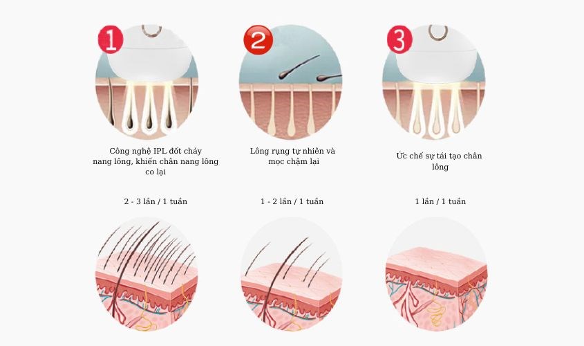 c Máy triệt lông Dr Glatt hiệu quả 100% sau 8 - 10 lần sử dụng