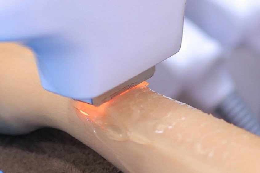 Trước khi triệt lông hãy điều chỉnh đầu phát xung tiếp xúc với da và vuông góc với da Trước khi triệt lông hãy điều chỉnh đầu phát xung tiếp xúc với da và vuông góc với da